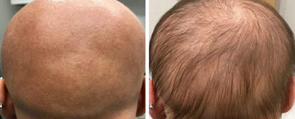 This teenage girl with allopecia suddenly grew hair thanks to a drug side-effect