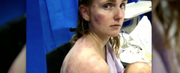 Australian woman's bruises show why you should never drive in a hailstorm
