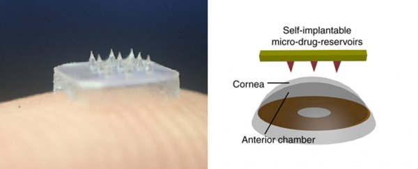 Scientists develop a spiky eye patch that injects drugs straight into the eye