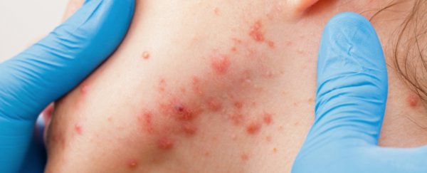 The most effective acne medication we have actually changes your skin's microbiome