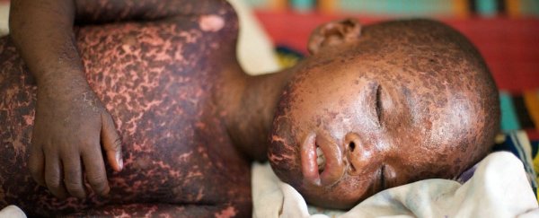 Measles are coming back around the world, and the reasons should make us ashamed