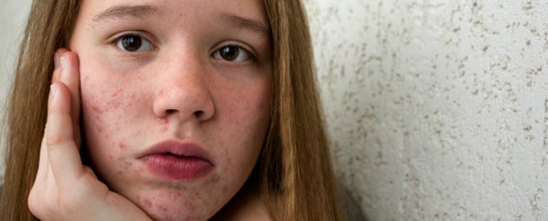 Whether or not you get acne could depend on your hair follicles