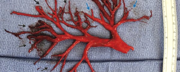 A man coughed up this perfectly shaped blood clot, stunning his doctors