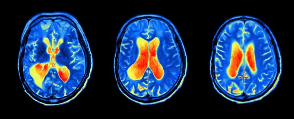 New Drug Trial Takes Different Approach to Stop Alzheimer's