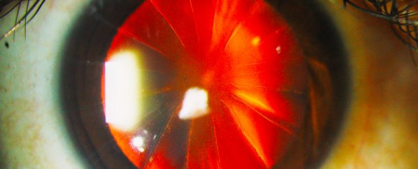 An eye surgery left this patient's cornea sliced up like a pizza