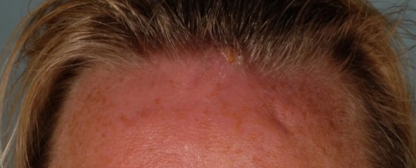 When this woman came back from vacation, something was living in her forehead