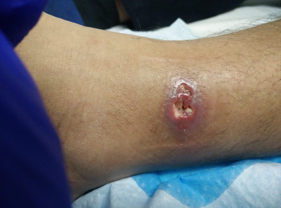 Alex's leg soon after starting treatment for the Buruli ulcer infection.