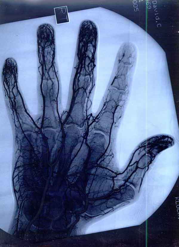 Hand blood vessels