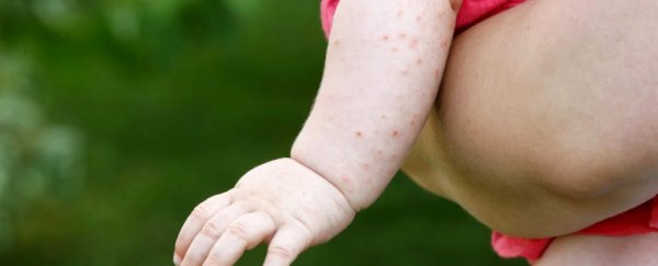 Pregnant women are being targeted by antivax ads online during a measles outbreak