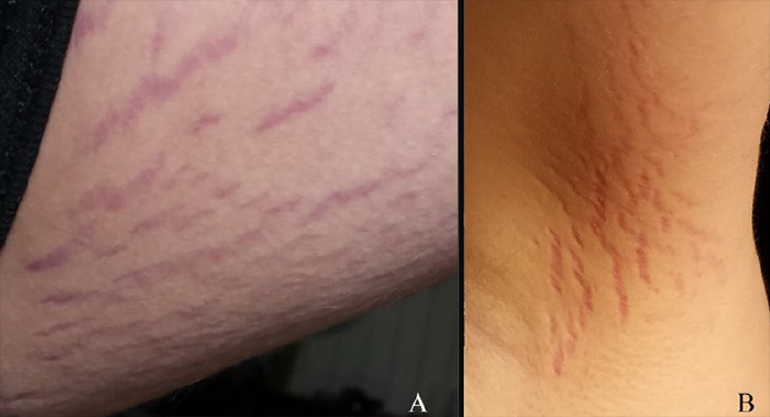 cat scratch stretch marks inset