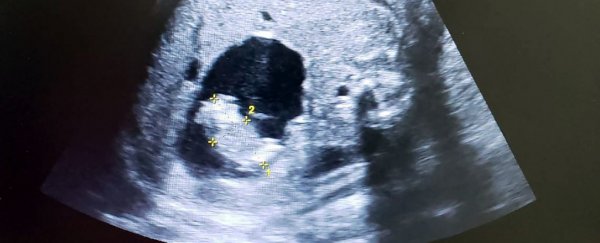 Incredibly rare case as baby in Colombia is born with her own twin growing inside her