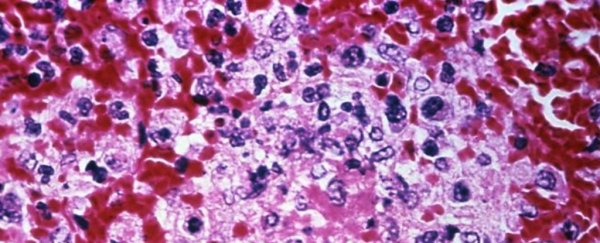 Deadly meningitis appears to be cleared with antipsychotics in early trials