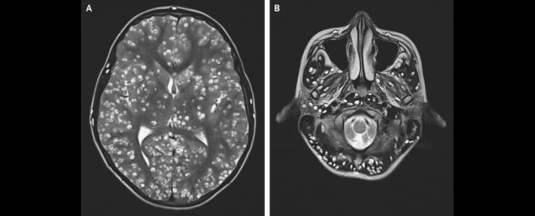 The white specks in this man's brain turned out to be something unimaginably horrible
