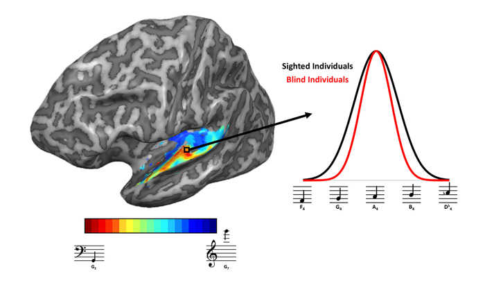 017 mri study confirms blind hearing 1