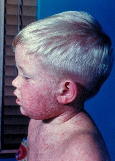 measles 3 day rash