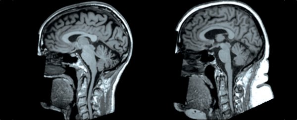 We now have more evidence of a worrying link between obesity and smaller brains