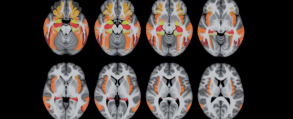 This shockingly common brain disease looks like Alzheimer's but is something else