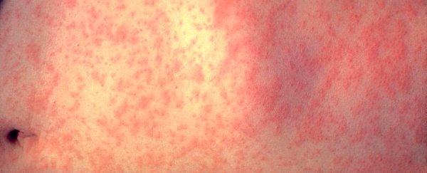 Unsure about vaccines? These brutal images show what measles actually does to kids