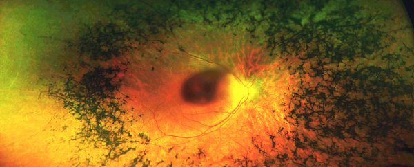 Doctors in Australia have found a strange genetic syndrome that's sending a family blind