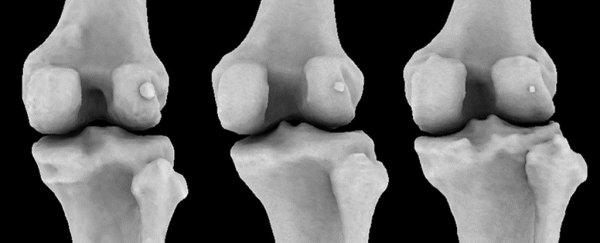 Mysterious bone discarded by evolution is making a comeback in modern humans