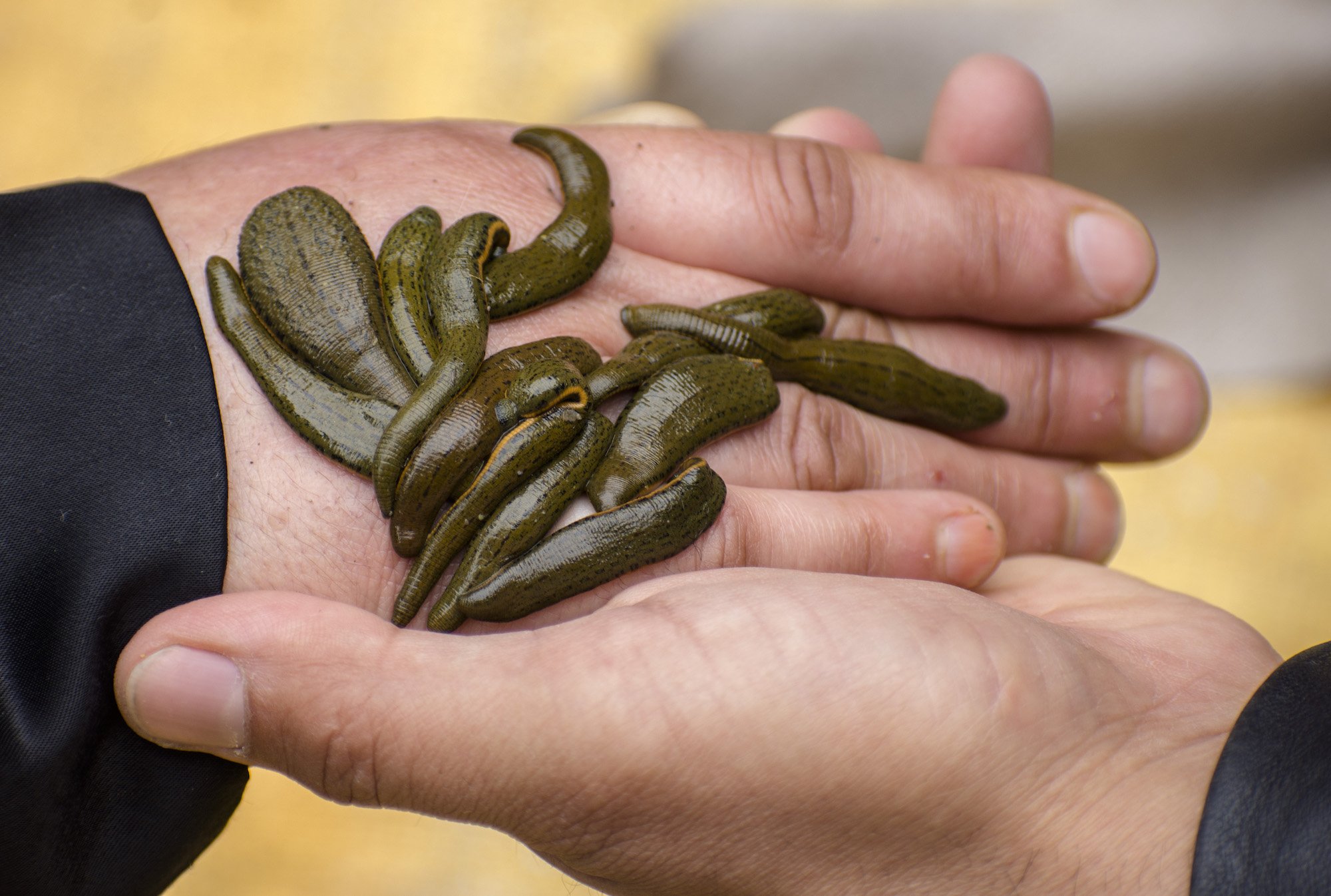 A woman receives leech therapy on her hand. (Getty Images/Yawar Nazir)