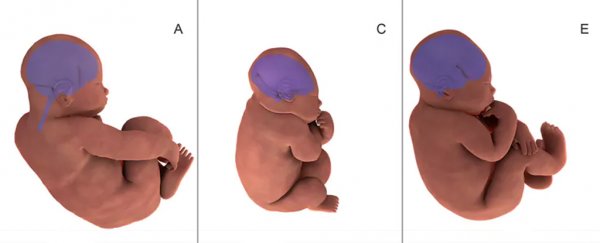 New study shows how much a vaginal birth really distorts a baby's body