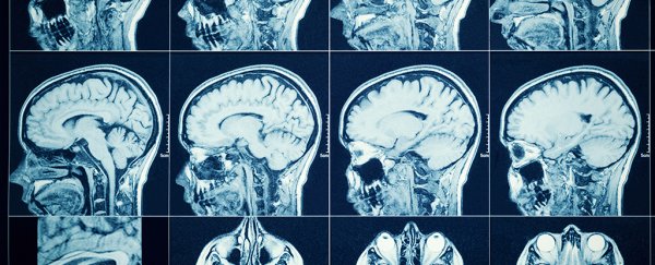 Alzheimer's changes can lie hidden for 30 years before symptoms appear, study reveals