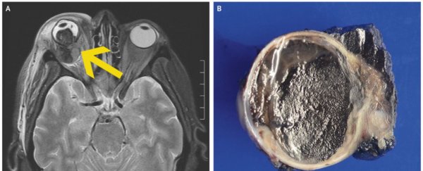 This is what happens if your eye pigment cells turn cancerous