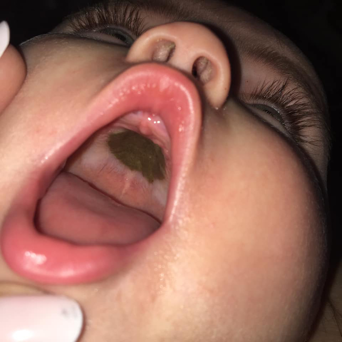 Glad Kro vinder Terrifying Dark Mark Inside Baby's Mouth Turns Out to Be Cardboard :  ScienceAlert