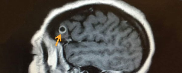 Surgeons opened a patient's skull to remove cancer, and found an unexpected visitor