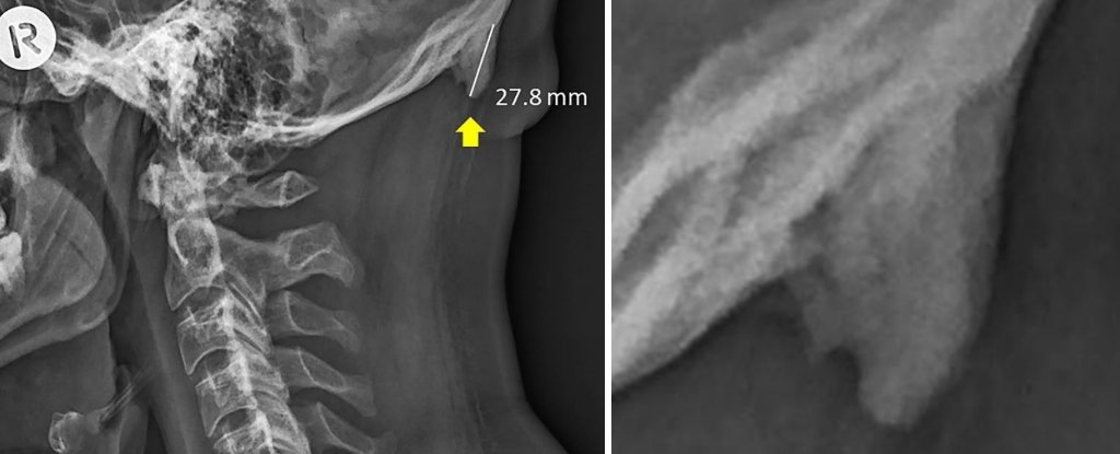 Young People Are Growing Weird Bumps On Their Skulls Study Says Sciencealert Young People Are Growing Weird Bumps On Their Skulls Study Says Sciencealert