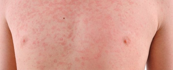 Recent unusual measles cases in Australia show why that second shot is so important