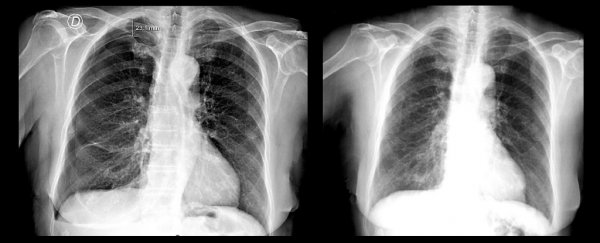 Acupuncture caused an elderly woman's lung to collapse