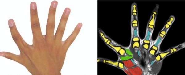 Having 6 fingers is not as useless as doctors thought, says study