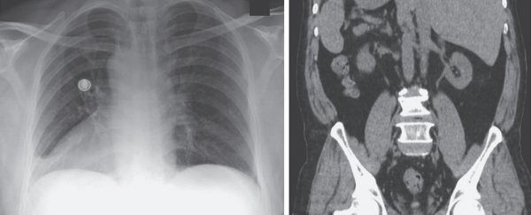 Wild case study reveals 66-year-old man with all his organs on the wrong side