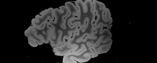 100-Hour-Long MRI of Human Brain Produces Most Detailed 3D Images Yet