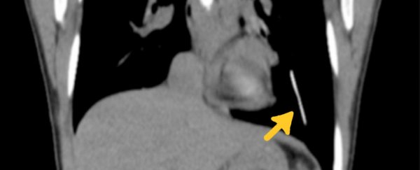 A woman's birth control implant moved from her arm to her lung without her noticing