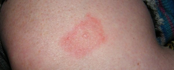 No, Lyme Disease Isn't An 'Escaped' Military Bioweapon. A Health Expert Explains Why