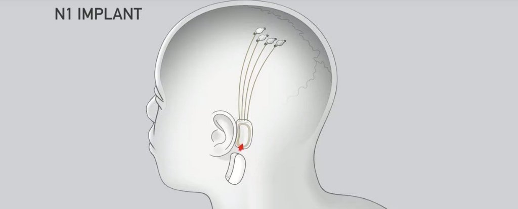 Elon Musk Wants to Put Slightly Creepy Implants Into People’s Brains as Soon as Next Year