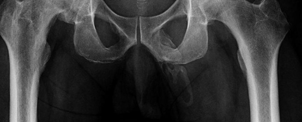 Doctors Take Hip X-Ray, Discover Patient's Penis Is Literally Turning to Bone - ScienceAlert thumbnail