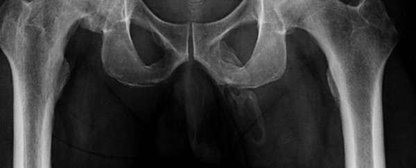 Doctors take hip x-ray, discover patient's penis is literally turning to bone