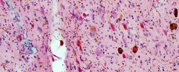 Alzheimer's appears to attack the neurons that keep us awake