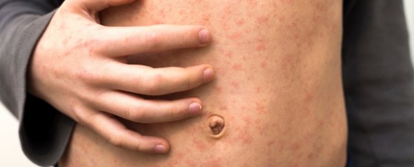 Texas Is Setting Itself Up For a Major Measles Epidemic, New study warns