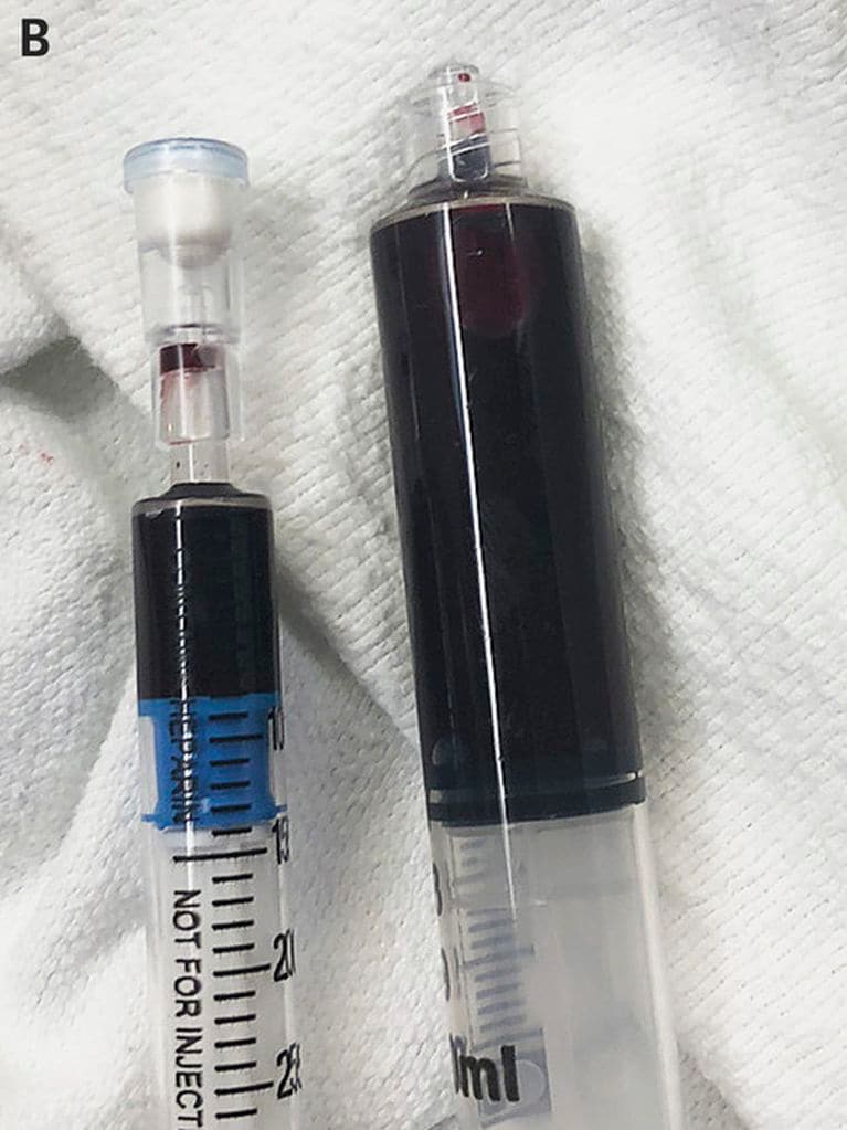 Blood samples from the 25-year-old woman diagnosed with acquired methemoglobinemia. (New England Journal of Medicine)