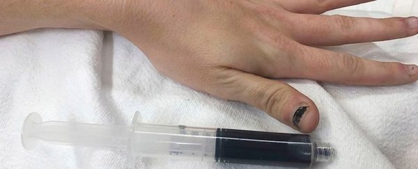 Woman shows up at hospital with "physically blue" skin due to a rare drug reaction