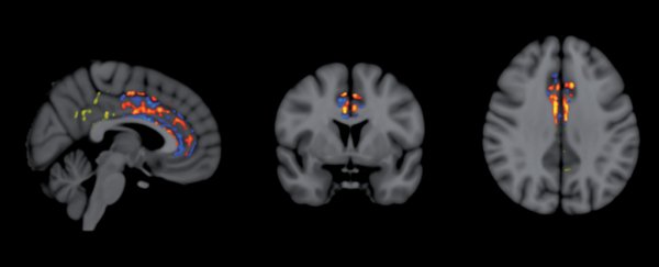Small trial reverses a year of Alzheimer's cognitive decline in just two months