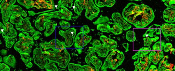Disturbing new evidence suggests soot particles can cross the placenta after all