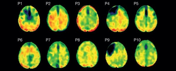 Just one head injury could be enough to tangle proteins in your brain