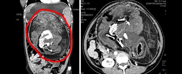 Teen's stomach pain turns out to be the half-formed remnants of her parasitic twin