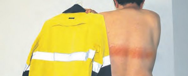 This Man Ended Up With First-Degree Burns From A High-Vis Safety Vest